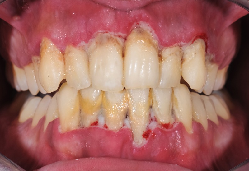 Showing the impact of periodontal diseases on human teeth by Dental Park