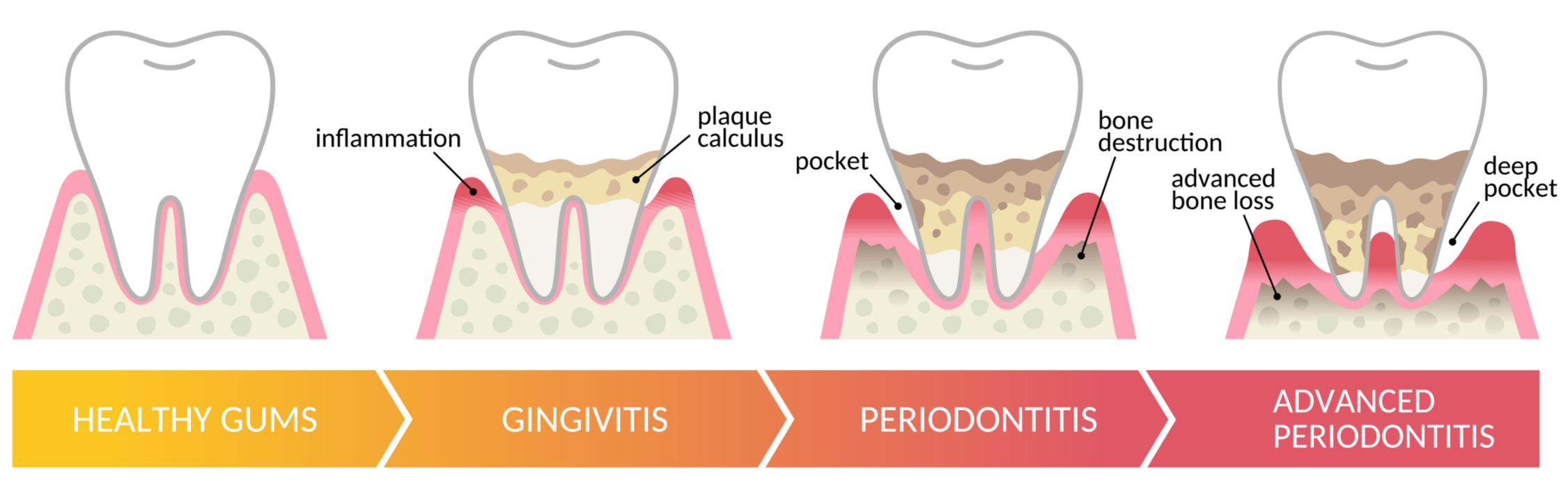 Infographic explaining periodontal diseases and treatment by Dental Park